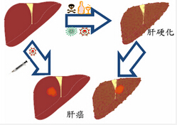 武安肝癌治疗