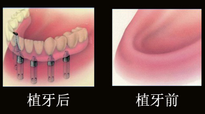 廊坊牙齿种植