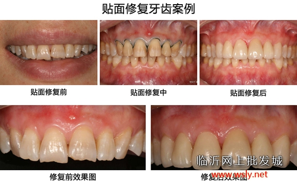 廊坊牙齿瓷贴面