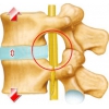 腰间盘滑脱治疗专业机构——腰椎监管狭窄治疗哪家好
